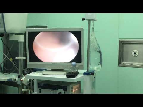 Problema con BPH Cazzo prostata