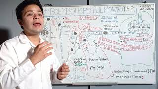 Fisiopatología Tromboembolismo Pulmonar Central (TEP - CENTRAL): Explicando aparición sintomatología