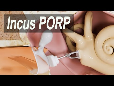 Incus Replacement - Partial Ossicular Replacement Prosthesis (I-PORP) for Hearing Loss