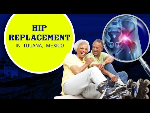 Watch Best Package for Hip Replacement in Tijuana, Mexico