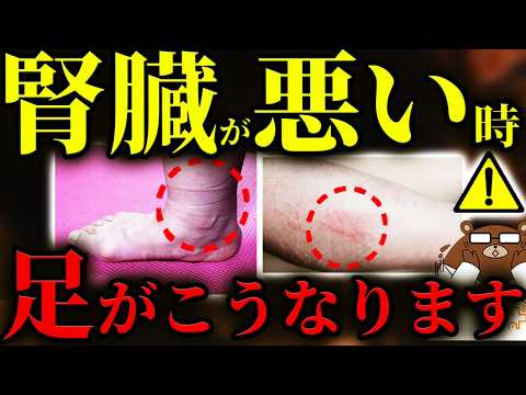 【超意外】絶対に知らないと後悔する腎臓が悪い時の「足」の危険サイン。むずむず.かゆみ.湿疹..意外な兆候とは？「痛風」は実は腎機能低下のサインだった？危険なむくみの見分け方とは？医師が完全解説。