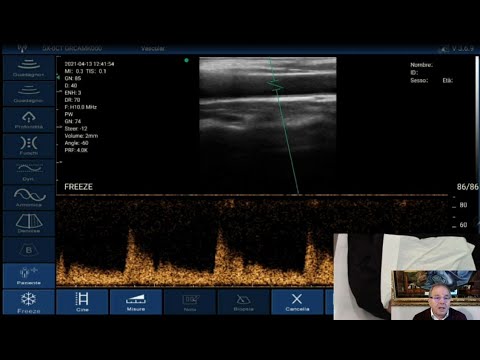 TUTORIAL ATL Scuola di Ecografia Bed Side - V Parte - Professor Mario Meola
