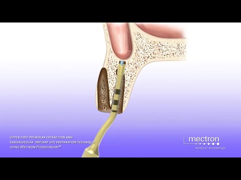 PIEZOSURGERY® - Upper first premolar extraction and endoalveolar implant site preparation procedure