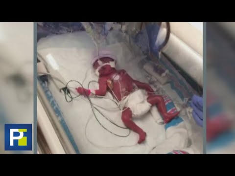 The story of the baby who was born at 6 months gestation and weighed 1.7 pounds