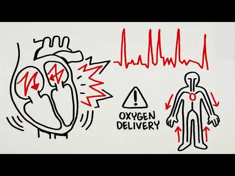 What is AFib? Symptoms, Stroke Risks, and Treatment Options Explained