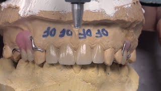 Case of the week: An Effective Solution for a Difficult Overbite Case