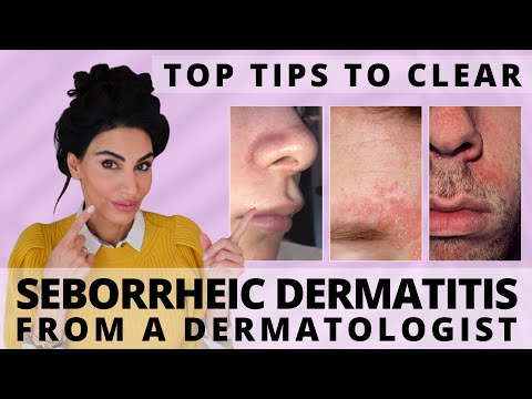 Top Tips to Clear Seborrheic Dermatitis | Dermatologist Deep Dive