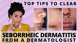 Top Tips to Clear Seborrheic Dermatitis | Dermatologist Deep Dive