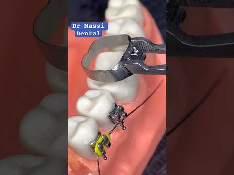 BRACES , ORTHODONTICS