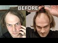 BALDING MEN With LONG HAIR GO BALD BEST TRANSFORMATIONS