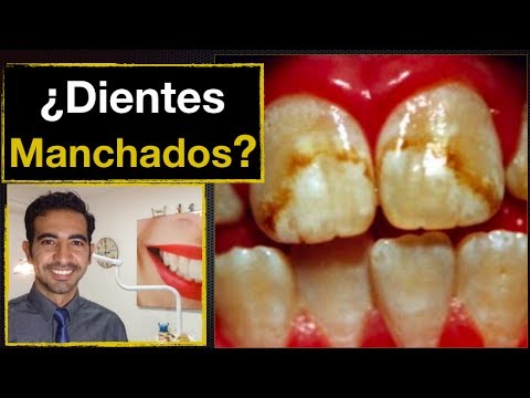 download lagu mp3 mp4 Manchas Amarillas En Los Dientes, download lagu Manchas Amarillas En Los Dientes gratis, unduh video klip Manchas Amarillas En Los Dientes