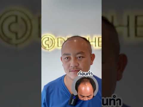 รวมความประทับใจปลูกผมที่ Dr.Chen Clinic