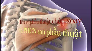 Phục hồi chức năng sau phẫu thuật chóp xoay