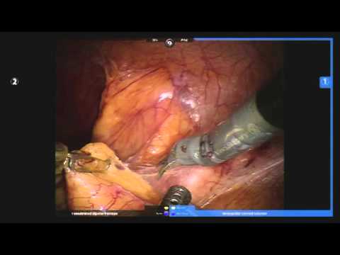 Complex Robotic Ureteroplasty Using Buccal Mucosal Onlay Graft