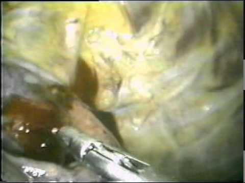 Video Assisted Thoracosopic Surgery (VATS)