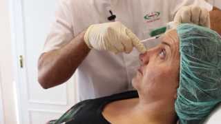 Botox al mejor precio en Madrid en Clínica Esbeltic Model