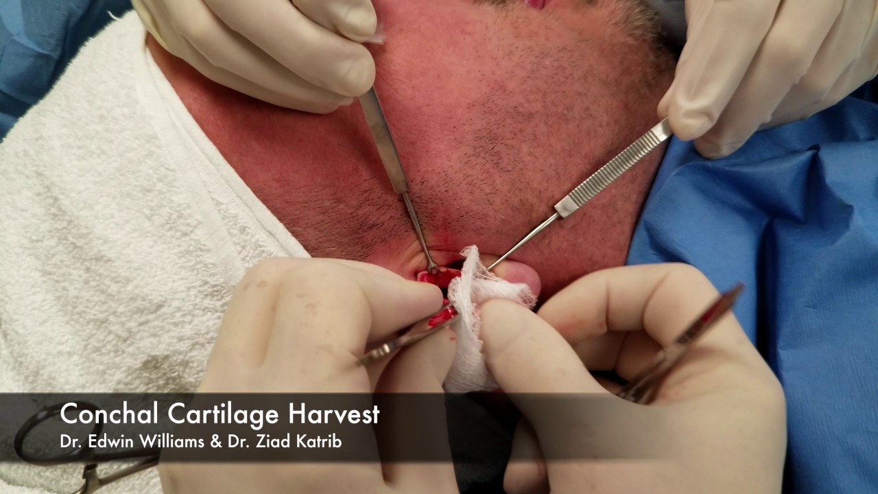 Watch Now Conchal Cartilage Harvesting - Surgical Footage Conchal Cartilage Harvesting - Surgical Footage