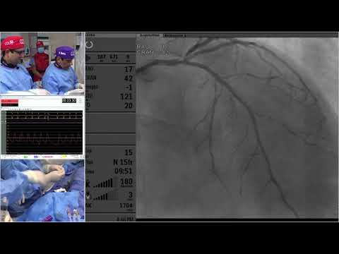 LC #11 - PCI of LAD using Atherectomy - CCC 2019