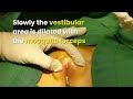 What Is A Hymen And How Does It Break Dr Ashutosh Shah Elegance Clinic Surat