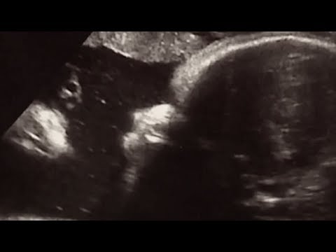 Click to Watch the Pennsylvania family saw Jesus in ultrasound, then received a miracle video Click to Watch the Pennsylvania family saw Jesus in ultrasound, then received a miracle video