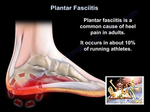 Plantar Fasciitis - Everything You Need To Know - Dr. Nabil Ebraheim