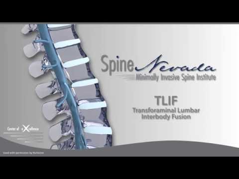 Minimally Invasive TLIF at Spine Nevada in Reno, Sparks, Carson, Sacramento