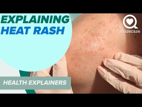Explaining Heat Rash And How To Treat It | Health Explainers | Sharecare