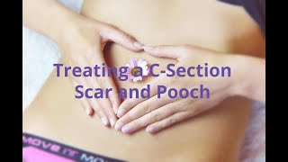 Treating a C-Section Scar and Pooch - Tannan Plastic Surgery in Raleigh NC
