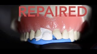 How the dentist repairs a chipped tooth
