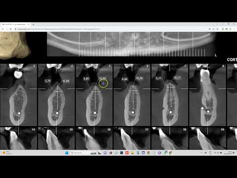 DESCARGA Y CARGA DE DICOM en ROMEXIS VIEWER