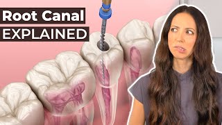 What Is A Root Canal &amp; Should You Get One