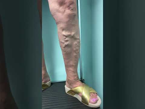 Diagnosticarea piciorului varicos
