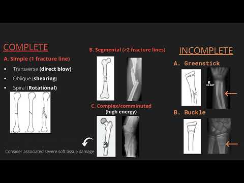 Approach to describing fractures on x-ray