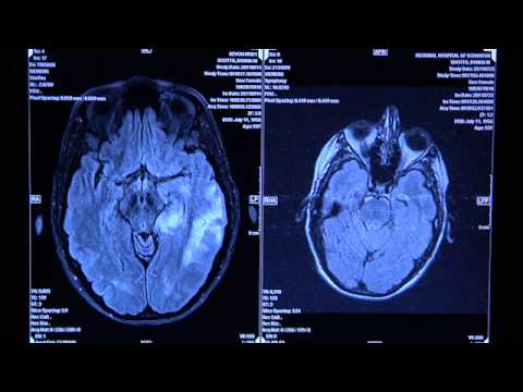 MRI imaging of a PML infection