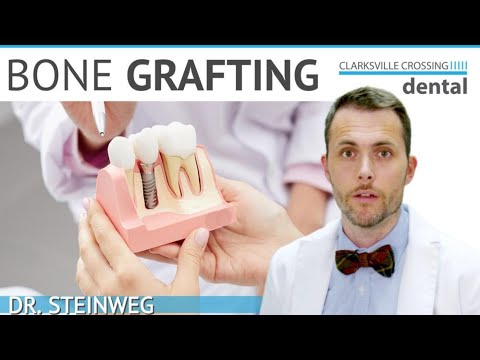 What Is BONE GRAFTING? 🤔 Dental Implant Surgery 🦷 Bone Loss