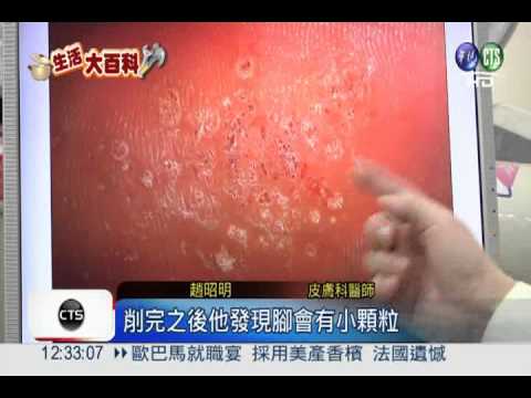 磨腳皮當心! 器具消毒不慎恐爛腳