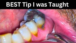 5-Minute Molar Fix – No Anesthetic Needed!