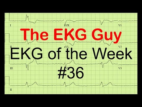 EKG/ECG of the Week #36 | The EKG Guy - www.ekg.md