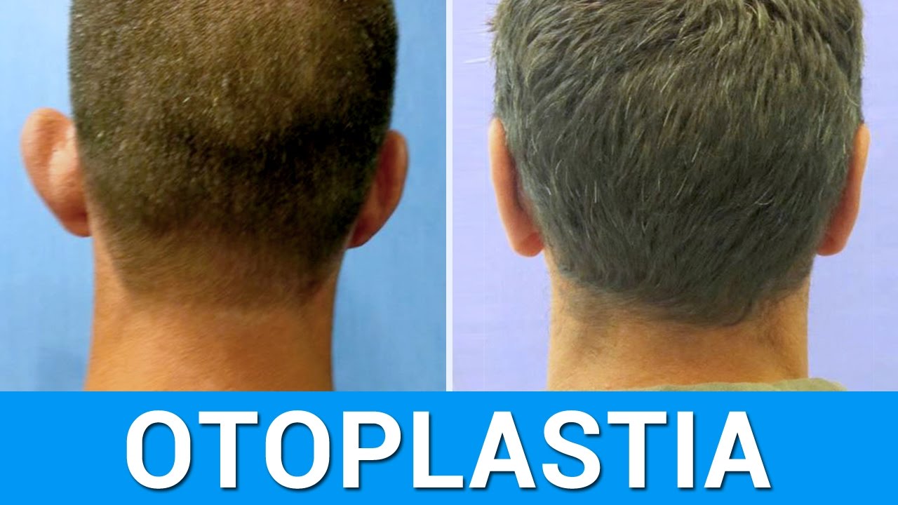 Watch CirugÃa de Orejas de Soplillo | Testimonio Raul GarcÃa Now CirugÃa de Orejas de Soplillo | Testimonio Raul GarcÃa