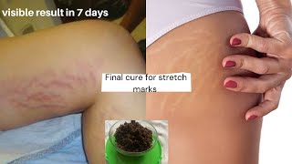 How I truly got rid of stretch marks fast 2 DIYHomeRemedies +Reviews #stretchmarksremoval #scar