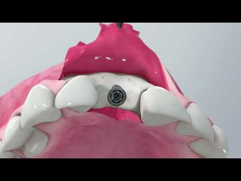 Bio-Oss Collagen (Био-Осс Коллаген) костнозамещающий материал - фото 1 - id-p738246401