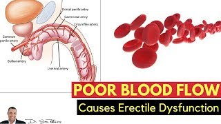 💋 How Poor Blood Flow Causes Erectile Dysfunction &amp; How To Quickly Fix It - by Dr Sam Robbins