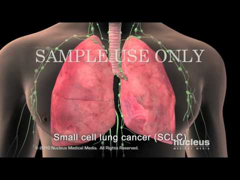 Small Cell Lung Cancer Staging