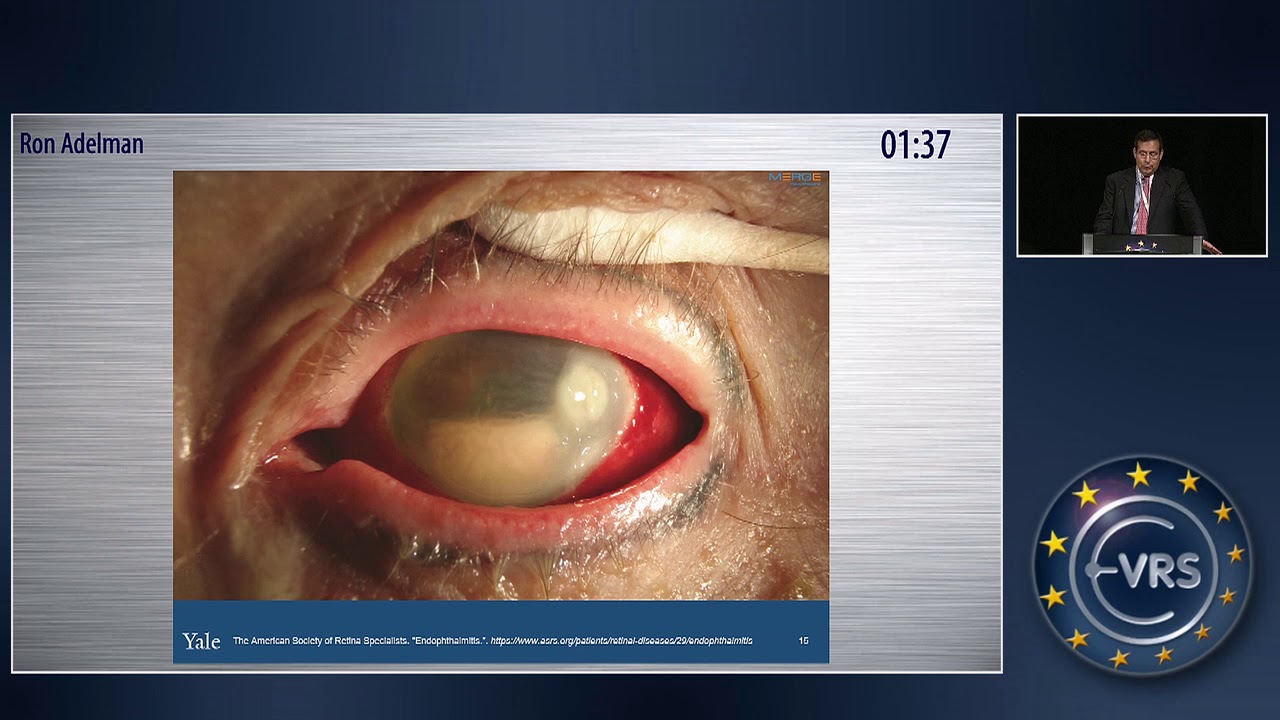 TASS and Endophthalmitis