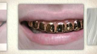 Gold Teeth Crowning