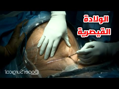 شاهد عملية الولادة القيصرية وقل سبحان الله الخالق cesarean section surgical technique hd video