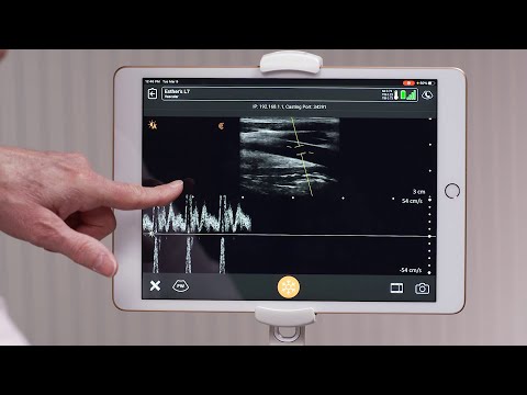 Clarius Feature: Pulsed-Wave Doppler Mode