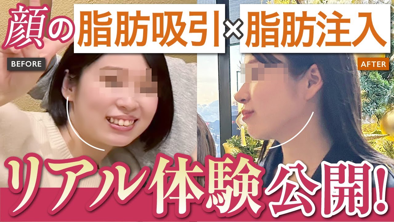 顔の脂肪吸引後、吸引した顔の脂肪を捨てるのはもったいない！おでこ脂肪注入の体験レポート