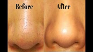 How to Shrink Large Pores on Nose Overnight - Large Pores On Nose Treatment
