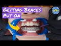 Process of Getting Braces